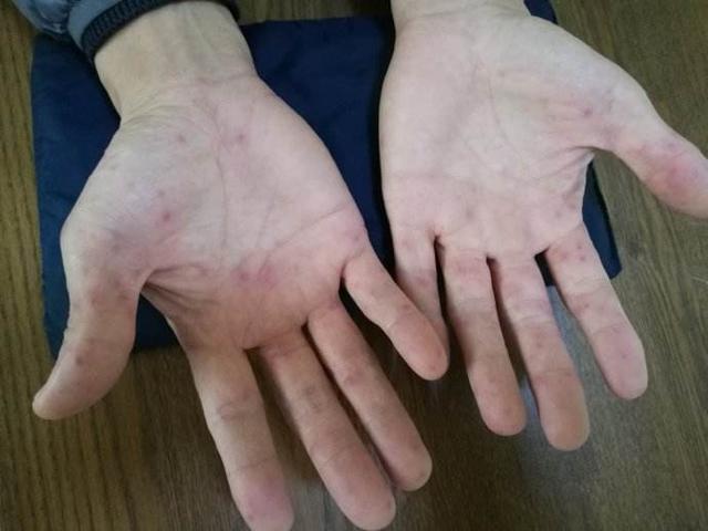 62岁大爷查出艾滋病,医生提示:4个信号要注意,可能已感染