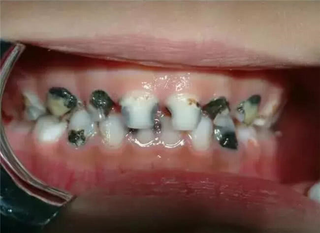 5岁女孩不吃糖牙齿却全烂光,大夫检查后,大骂奶奶的无知|牙齿|蛀虫