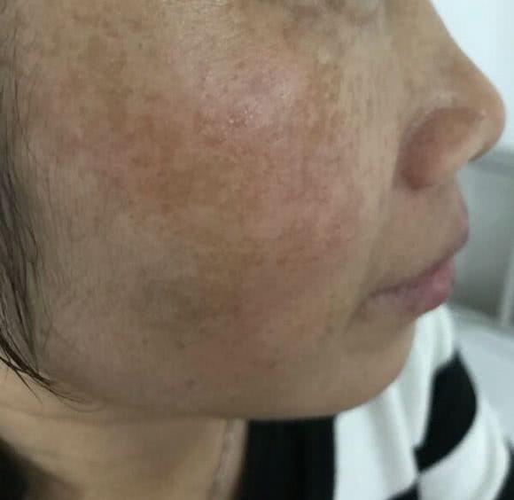 38岁内分泌失调满脸黄褐斑医生2招对付她成治愈案例