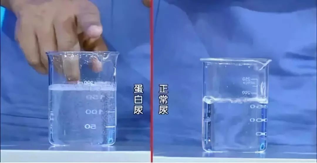 蛋白尿,血尿怎么查?看懂这几个尿检指标,掌握肾健康!