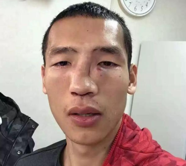 拳击哥鼻子被打歪,赛后首次说出心声,看后心里酸酸的