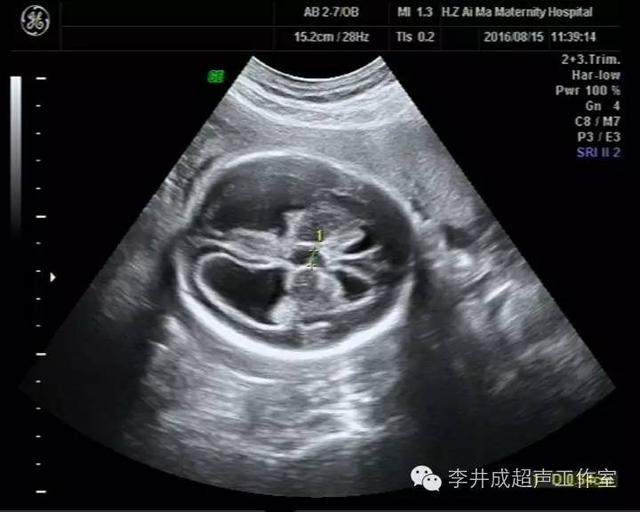 脑积水|胎儿|畸形_新浪新闻