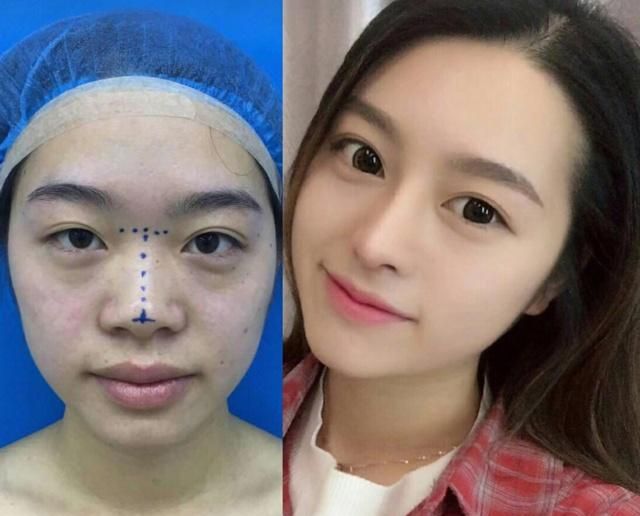 隆鼻前后对比,隆鼻三年经验分享:不要打玻尿酸,鼻综合选择慎重