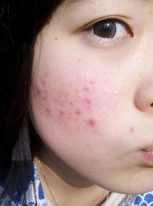 脸上若有这4种情况可能是螨虫在捣鬼