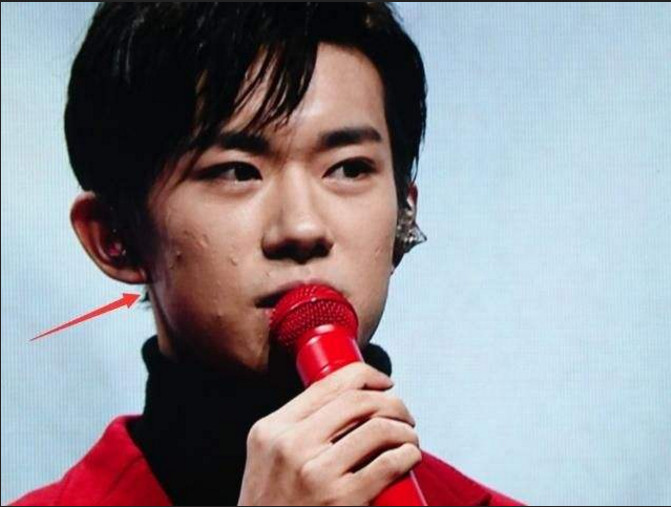 易烊千玺发布会未修图照被疯传,暴露真实颜值,满脸青春痘很抢镜