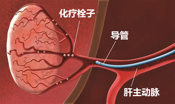经肝动脉化疗栓塞(tace)是目前公认的肝癌非手术治疗的最常用方法之一