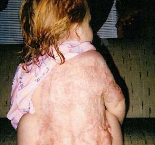 地把哭喊的女儿救了出来,挽回了一条命,可还是没能免受严重烧伤的厄运