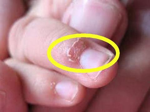 孩子手上长倒刺,是身体缺啥吗?原来通过手指可以看出这么多秘密|倒刺|皮肤|手指|指甲|家长_新浪新闻