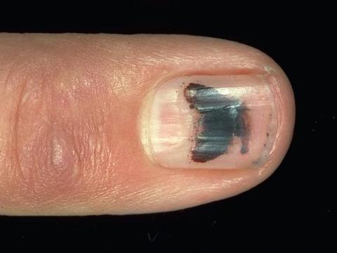 指甲上长了黑线,是不是传说中的黑色素瘤?判断方法看过来