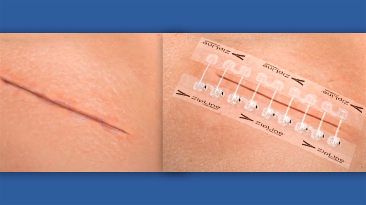 美国发明伤口愈合拉链,手术不用缝线,轻松一拉就搞定!