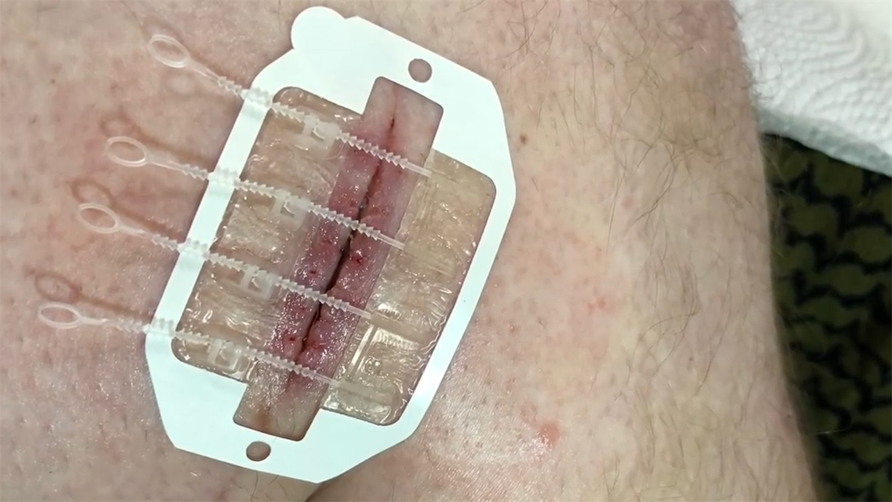 美国发明伤口愈合拉链,手术不用缝线,轻松一拉就搞定!