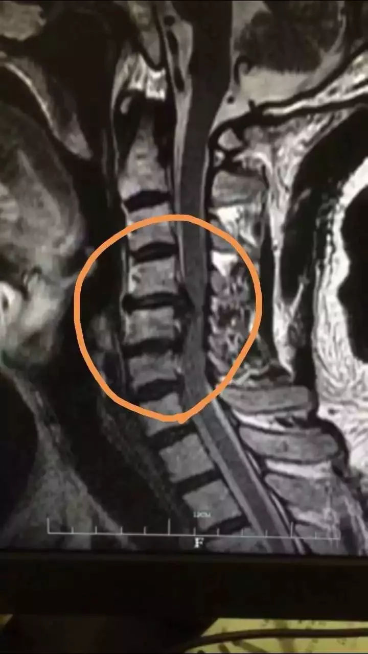 一男子睡火车卧铺,差点睡成瘫痪!国庆出游要注意!