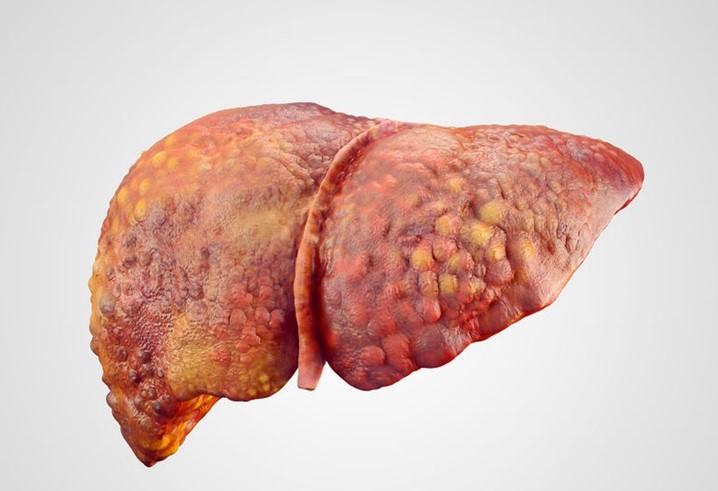 肝脏病变有哪些症状,肝病早期的六大症状-花瓣养生-花瓣饮食养生-花瓣