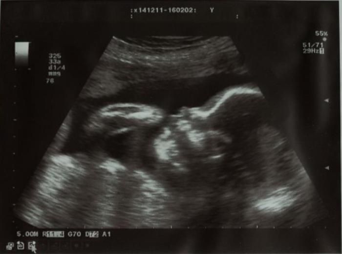 怀孕四个月宝宝b超能看出胎儿的性别吗