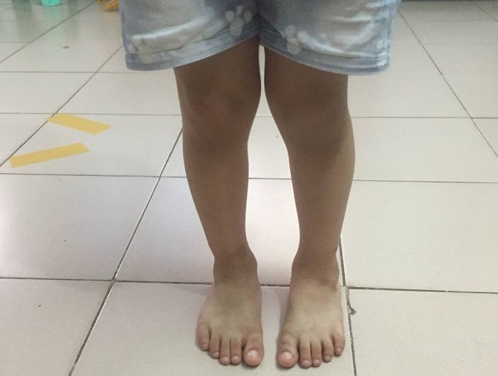 孩子o型腿,x型腿是什么原因造成?不要担心,2岁前可适当干预