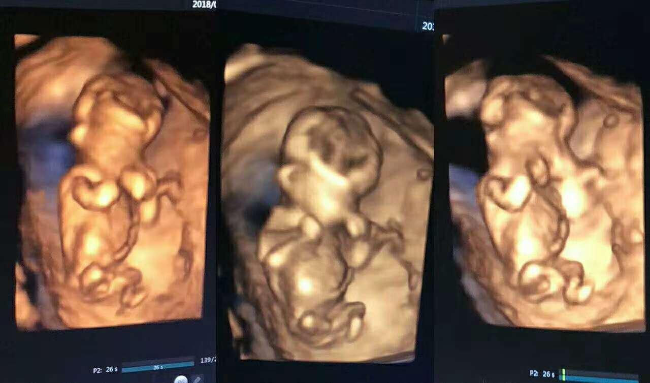 关于NT检查你了解多少?|胎儿|B超|孕妇|皮肤|宝宝_新浪新闻