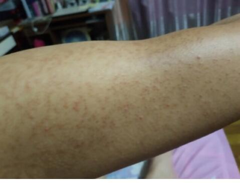 大臂有鸡皮疙瘩怎么去除(胳膊肘好多鸡皮疙瘩怎么去除) 大臂有鸡皮疙瘩怎么去除(胳膊肘好多鸡皮疙瘩怎么去除)