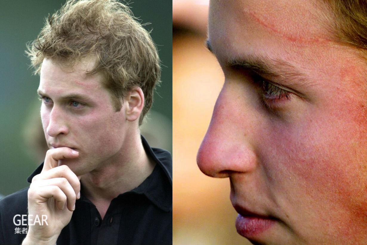 和老婆的甜蜜巧合威廉王子脸上也有一道harrypotter疤痕