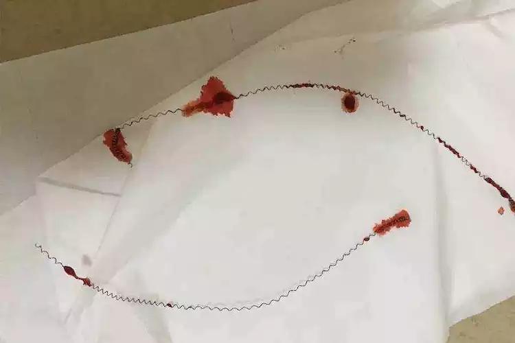 为生二胎,宝妈医院取出节孕环,没想到已经变成如此模样