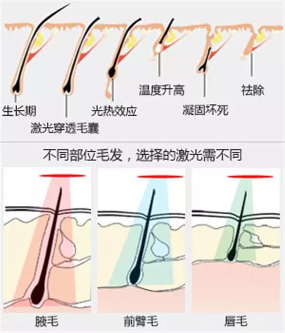 激光脱毛不是永久性的吗?为什么还会长出小绒毛