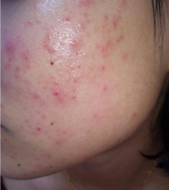 教你3招,轻松祛痘不复发|祛痘|螨虫|痘痘_新浪新闻