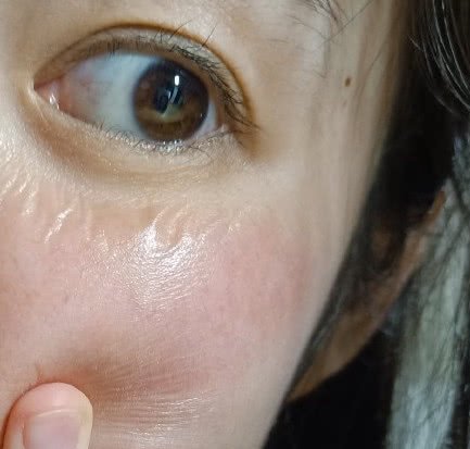 林允因工作脸过敏,严重到脸上全是褶子,没时间治疗令人心疼!