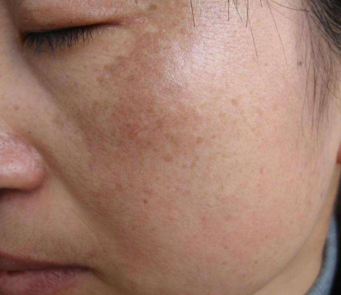 斑点在脸上"扎根",用对2招,内调 外涂清理,脸蛋白净