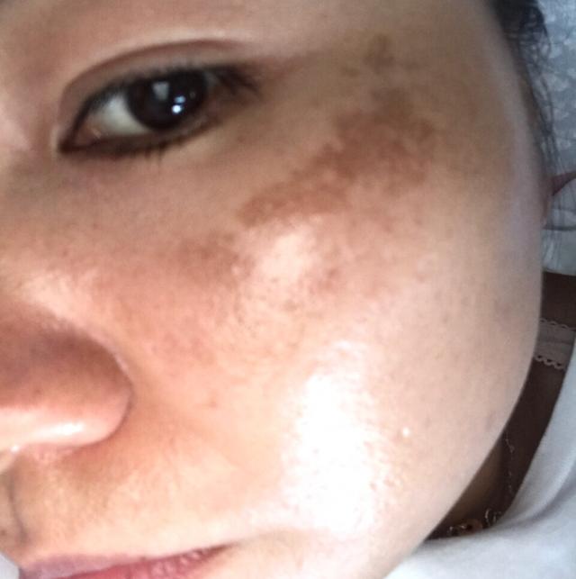 医生研究黄褐斑的克星发现3种食物混合能祛斑治愈案例公布