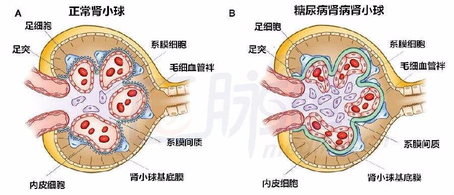 皮肤有2个变化颈部出痱子说明糖尿病肾病已来别忽视
