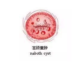 发现宫颈纳囊时,不要掉以轻心,在日常生活中需要多加注意:1,宫颈囊肿