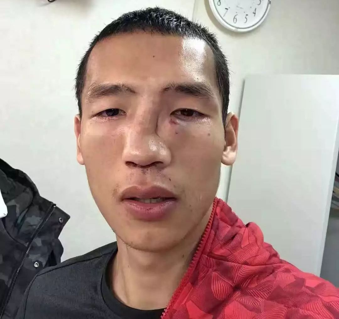 五位中国拳手赴日本挑战惨遭团灭,"拳击哥"鼻骨骨折遗憾退赛!