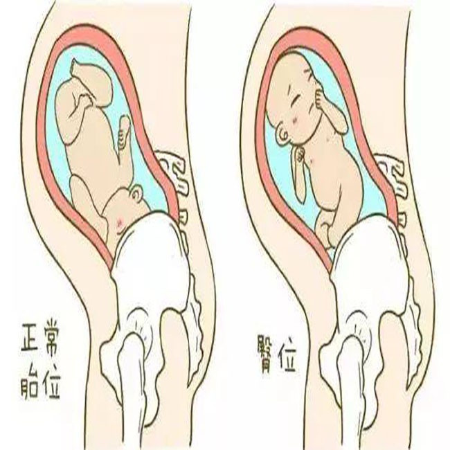 33周之前一直是头位33w4去查又成臀位宝宝还可能自己转头吗