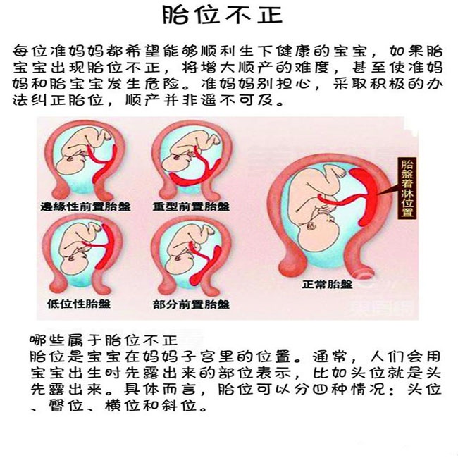 胎儿臀位且脐带绕颈2周能顺产吗听听医生怎么说早知早安心