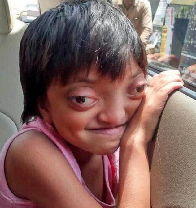 女孩出生眼睛就比较大,父母认为很好看,结果女孩长大后却愁坏了