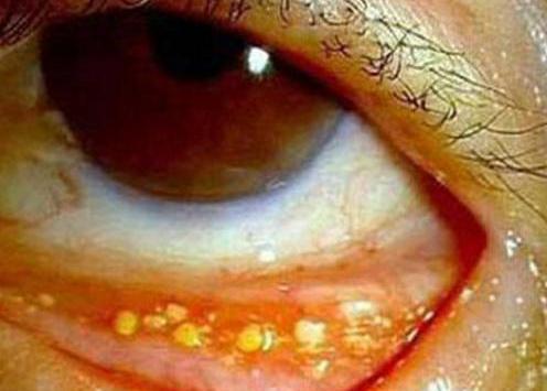 10岁孩子眼睛里满是小颗粒,医生检查完称是石头,都是手机害的