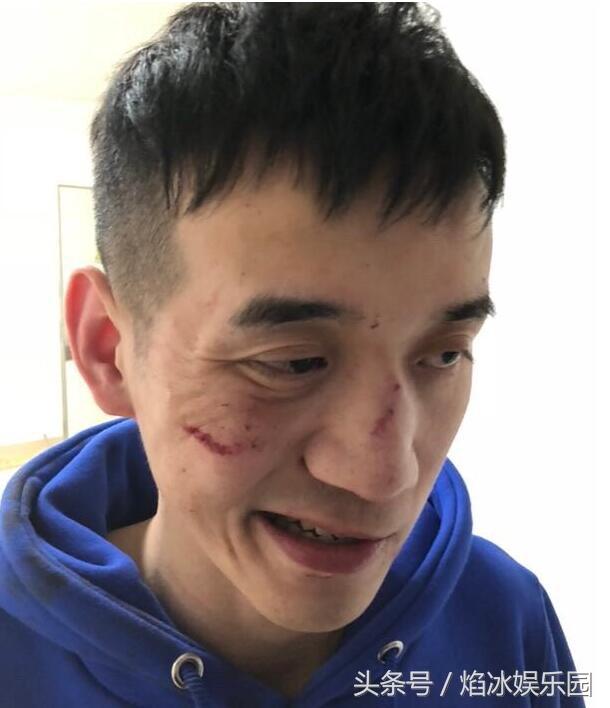 贝拉拉|打人者|鼻骨骨折_新浪网