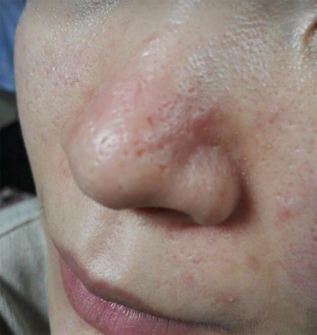 螨虫脸对照表一看就知道你是属于哪一类