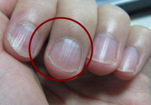 指甲上如果出现了"竖纹",一般和3个原因有关,别掉以轻心