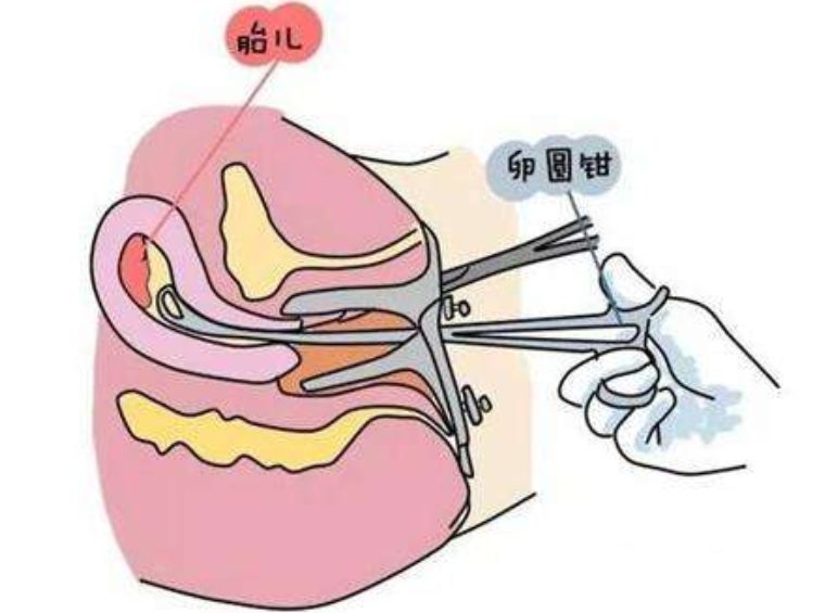 采取的避孕方式不正确.