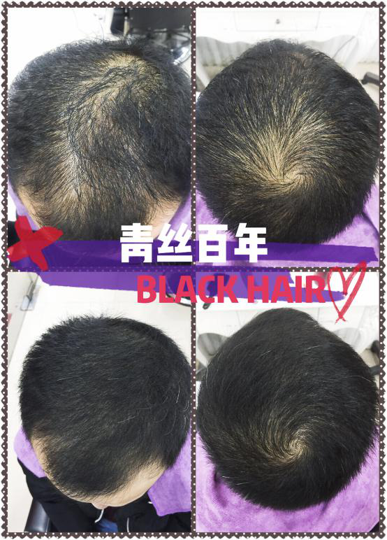 苏州白发转黑:白发为何偏偏找上你?__财经头条