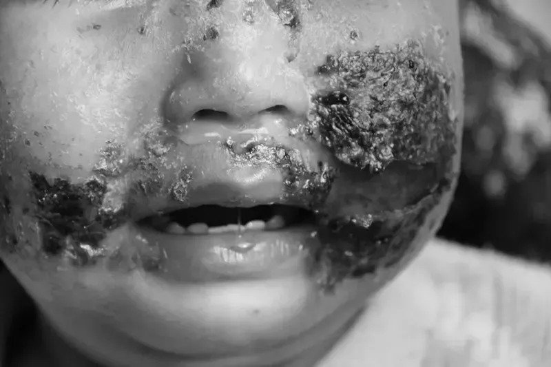 6个月宝宝脸被捏烂谁再这样捏我宝宝我就跟他断交