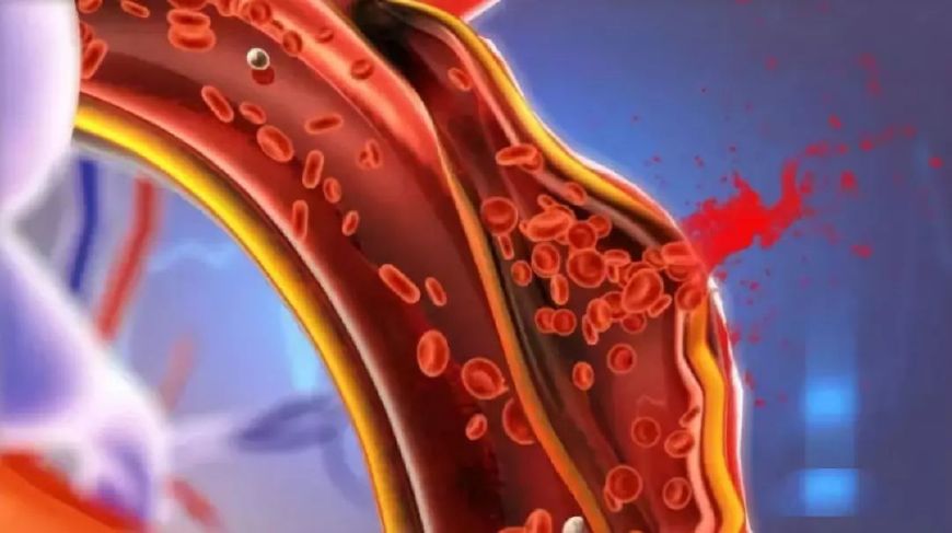 主动脉夹层:这种疾病太凶险!胸背出现撕裂痛,千万要警惕!|主动脉夹层|