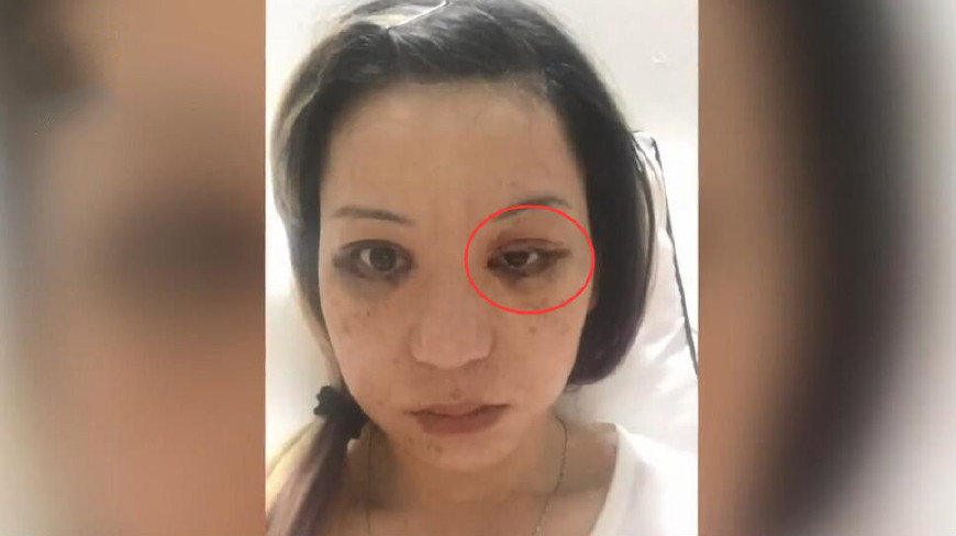 湖北女士割双眼皮失败,朋友圈吐槽却被整容医院索赔20万