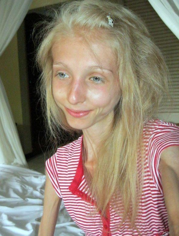 24岁女子减肥变成骷髅体重只有42斤网友直呼就像活干尸