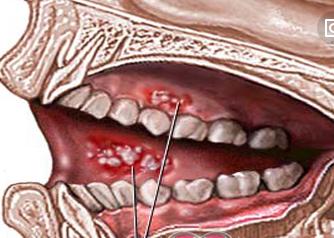 中医带你认识牙龈癌