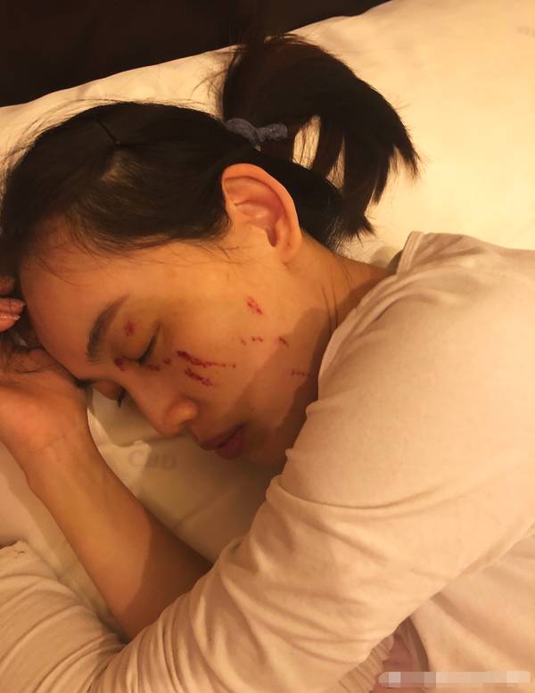 马蓉被打受伤照曝光,脸部头部伤痕明显,背部都已发黑