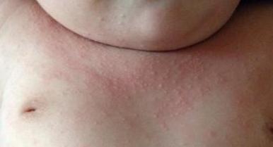 小孩胳膊起鸡皮疙瘩有皮屑(小孩胳膊起鸡皮疙瘩有皮屑怎么办) 小孩胳膊起鸡皮疙瘩有皮屑(小孩胳膊起鸡皮疙瘩有皮屑怎么办)