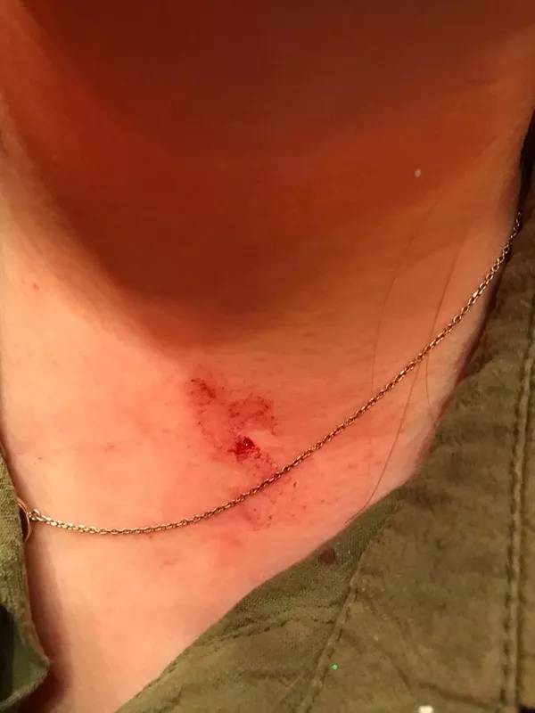 提示:以下图片可能会引起不适,请谨慎浏览 ▲另一位女服务员脖子受伤