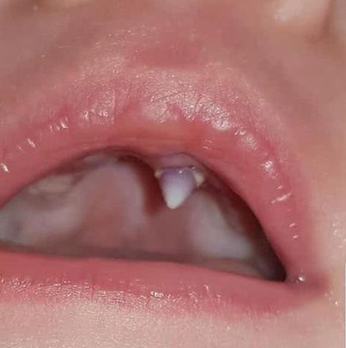 吸血鬼11周小宝宝在一夜之间长出一颗锋利牙齿吓坏父母