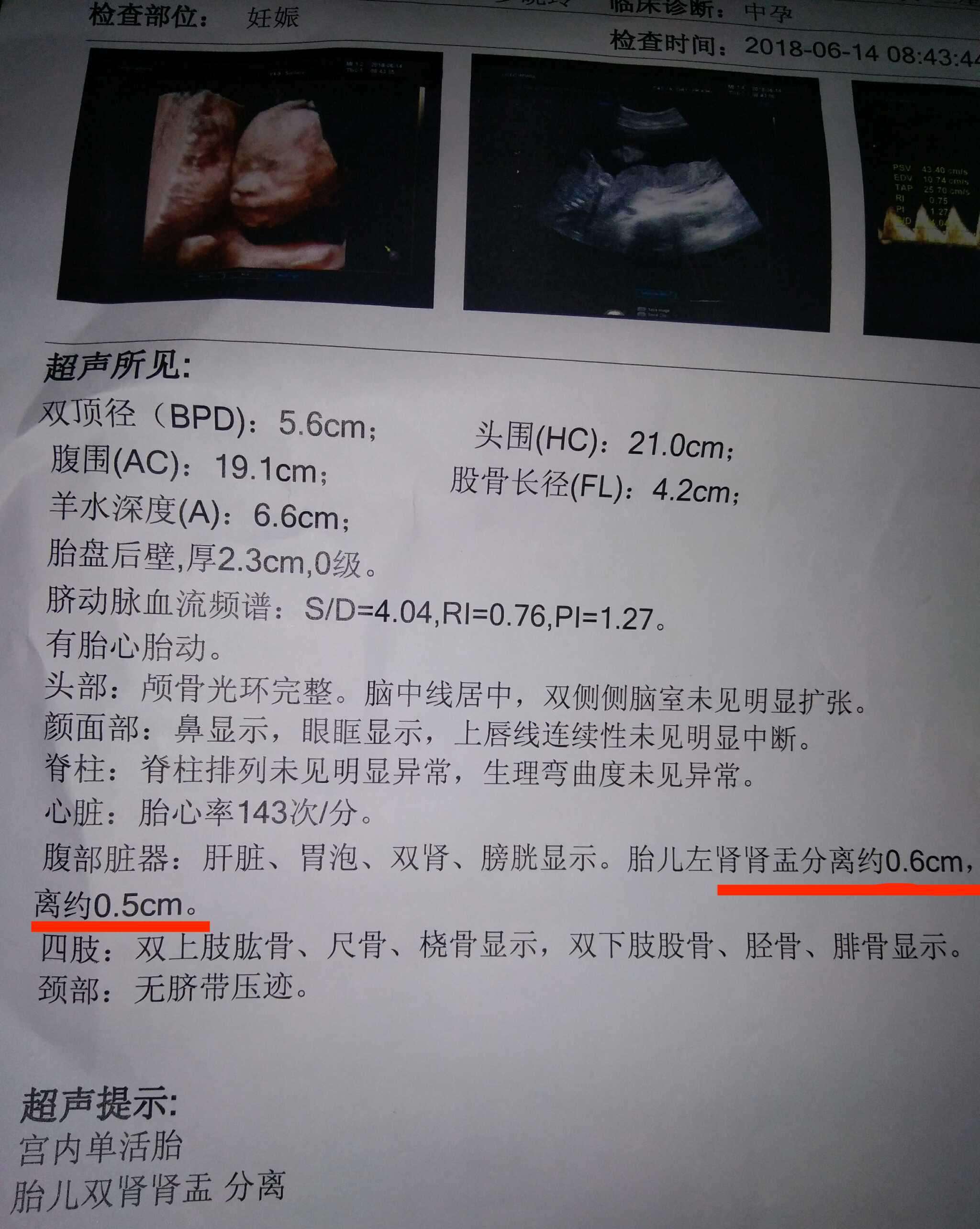 b超单上的"肾盂分离"代表啥?医生的解释和孕妇的经历更真实